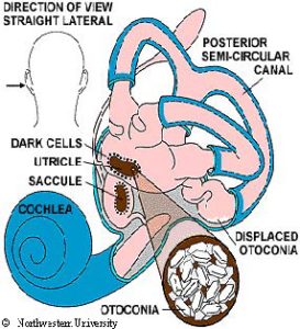 Vertigo: BPPV