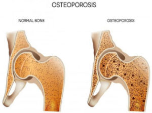 Osteoporosis Image